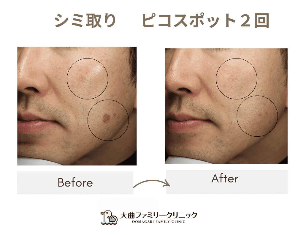 シミ取り　ピコスポット２回のBefore&After